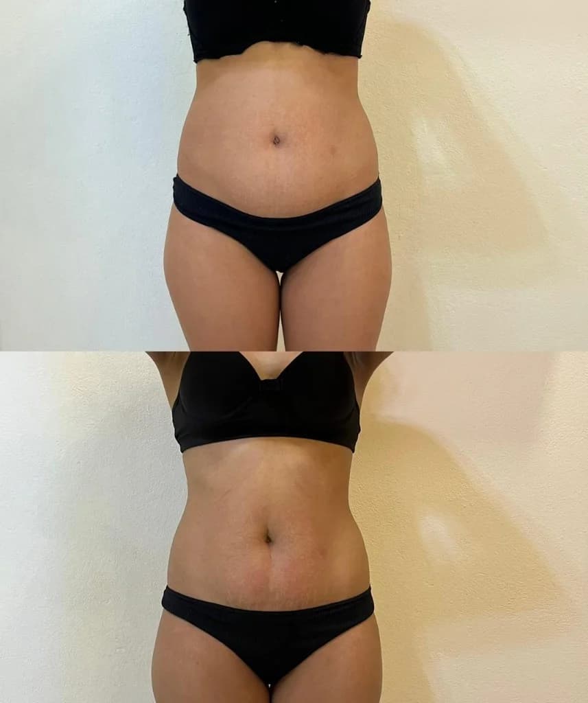 Registro autorizado de antes e depois abdominal em vista frontal