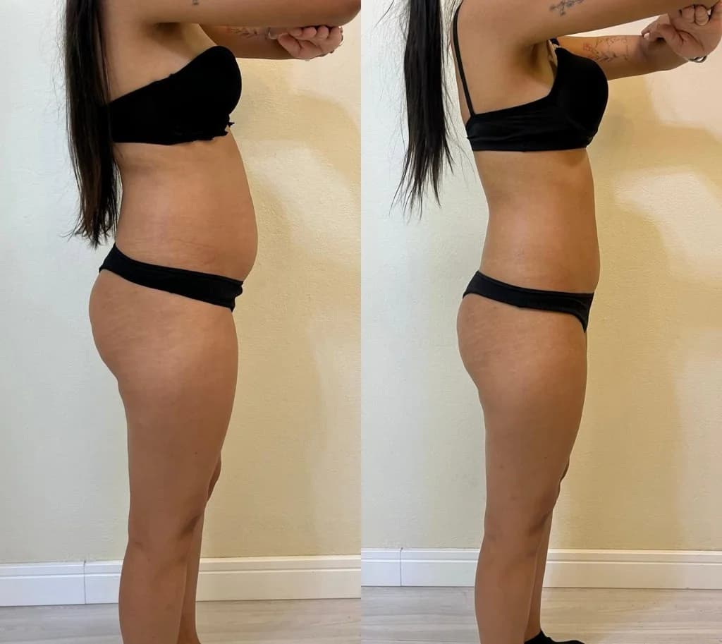 Registro autorizado de antes e depois abdominal em perfil
