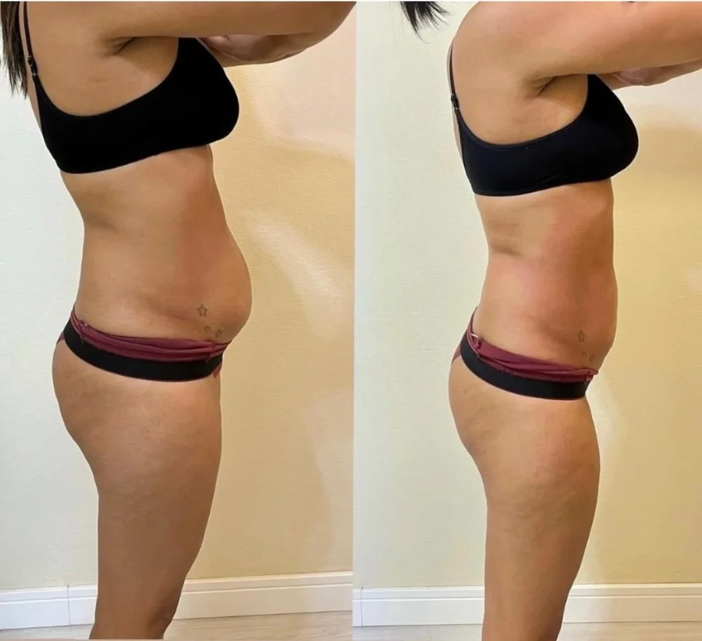 Registro autorizado de antes e depois abdominal em perfil lateral